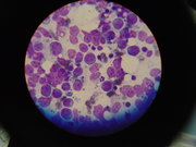 Cytology of lymphoma in a dog