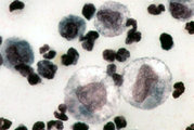 Cytology of FIP-induced fluid showing neutrophils, macrophages and lymphocytes